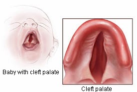 cleft palate small